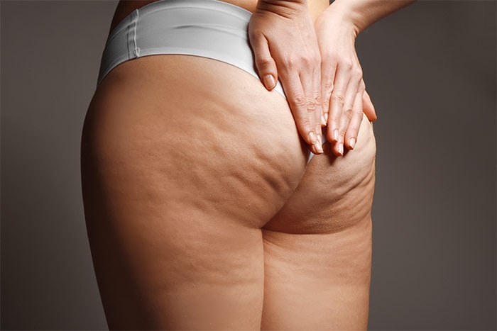 Cellulite su glutei e gambe