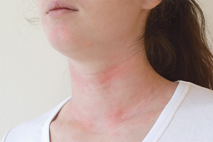 donna con eczema su viso e collo cause