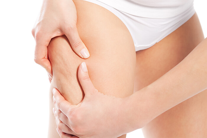 come contrastare la cellulite